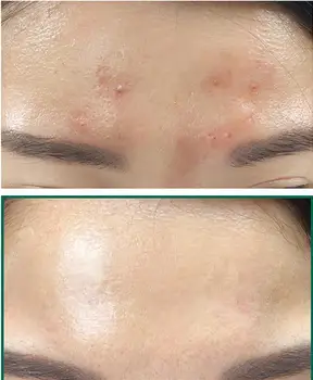 UNII DE MI Melc Truecica Miracle Repair Serum 50ml Acnee Tratament Facial Esența Cicatricial de Reparare Anti-Rid Crema de Fata Albire