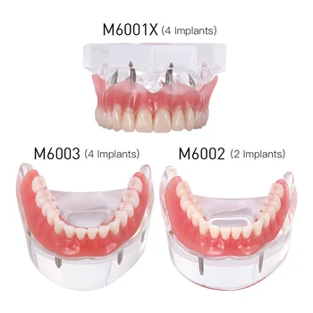 Implant Dentar Restaurarea Dintilor Model Detașabil Punte Dentară Demo De Boli De Dinți Model Cu Restaurarea Podului De Predare Studiu