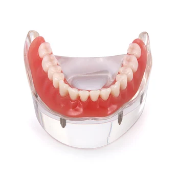 Implant Dentar Restaurarea Dintilor Model Detașabil Punte Dentară Demo De Boli De Dinți Model Cu Restaurarea Podului De Predare Studiu