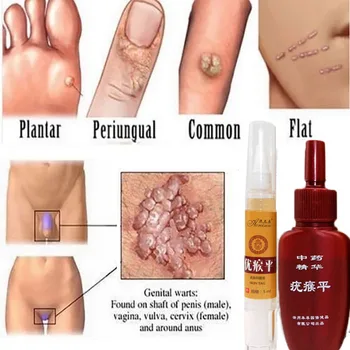 Pielea Tag Remover Împotriva Mol & Genital Wart rapid RemovWithin al Anti Picior de Porumb Eliminarea Negi, Papiloame Rapid elimină alunițele