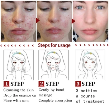 Centella Asiatica Reparații Acnee Profunda Facial, Acnee, Cicatrici Acnee Acid Hialuronic Faciale Esența Luminează Pete Intunecate