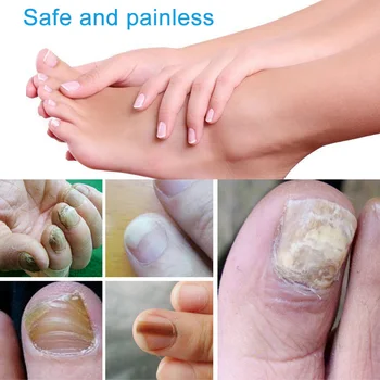 3ml Tratament Ciuperca Unghiilor Lichid Medicina Chineză Ierburi Unghii Deget de la picior Anti-Fungice Deget de la Picior Eficient de Reparare a Hrani Unghiile SSwell